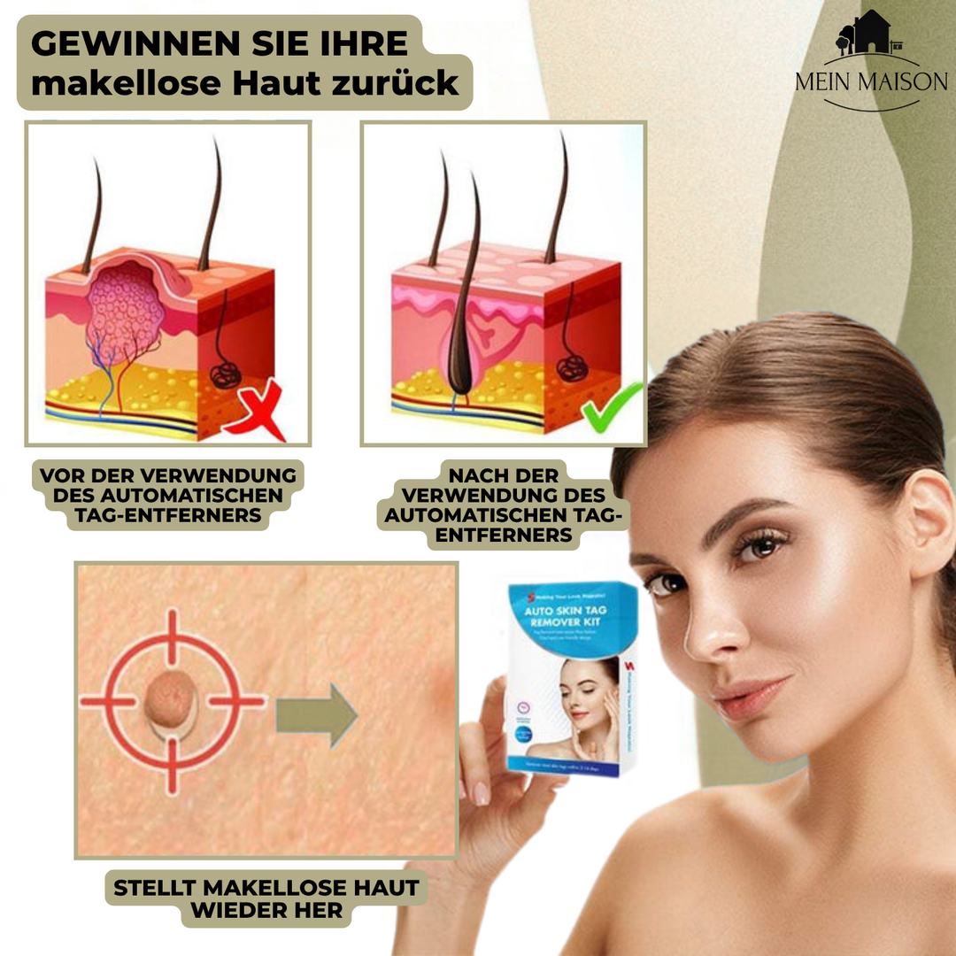 DermaLinx Fjern Vorter | Smertefri Fjernelse af Vorter og Modermærker | Til Hjemmebrug | Uden Kirurgi