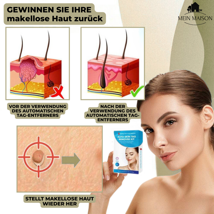 DermaLinx Fjern Vorter | Smertefri Fjernelse af Vorter og Modermærker | Til Hjemmebrug | Uden Kirurgi