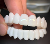 DentAlign tandfacader – Naturlig tilpasning og komfort