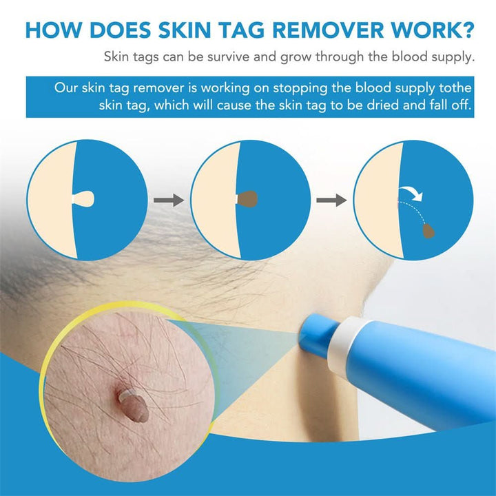 Dermaswift – fjerner hudpletter mod vorter og hudvækster