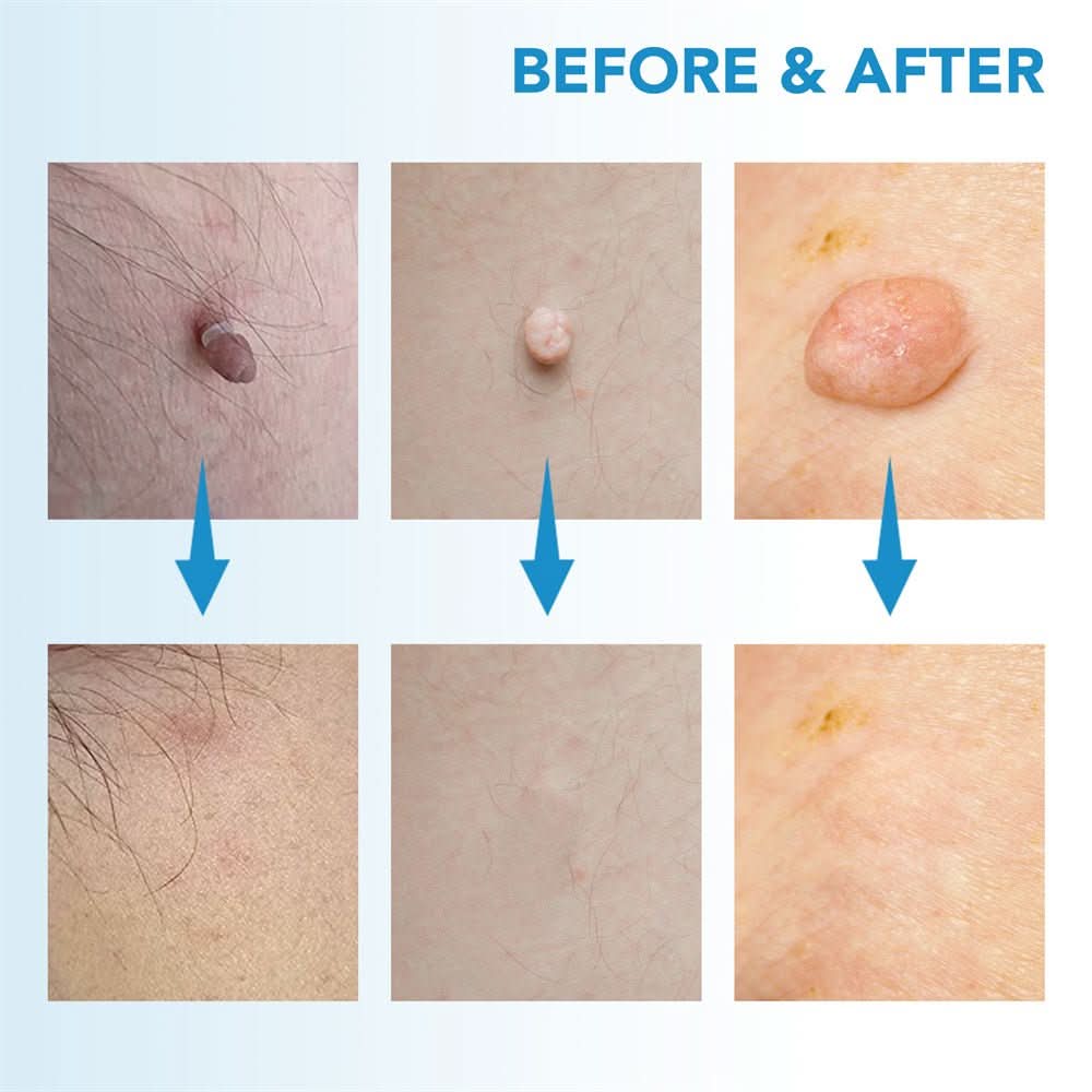 Dermaswift – fjerner hudpletter mod vorter og hudvækster