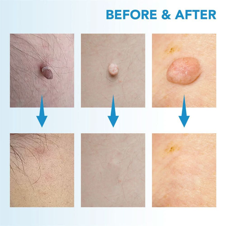 Dermaswift – fjerner hudpletter mod vorter og hudvækster
