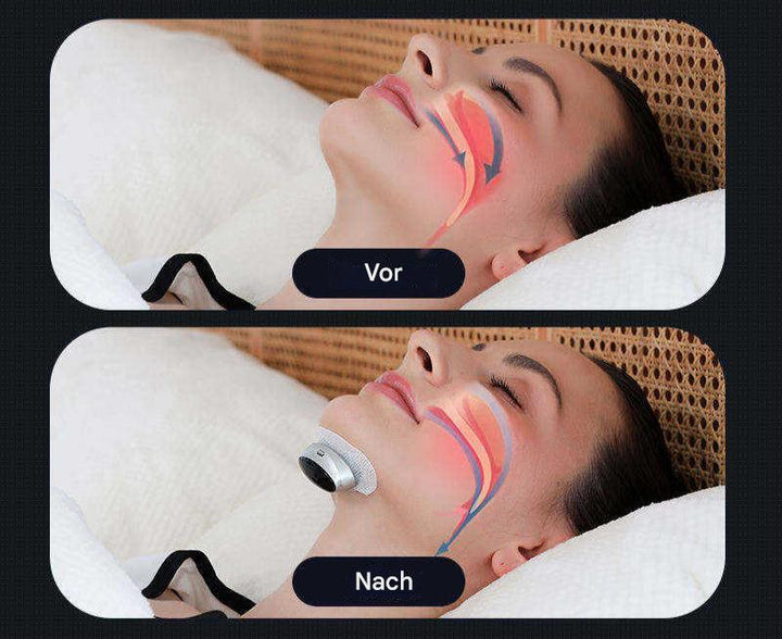 Anti-snorkeenhed til søvnapnø - AirEase